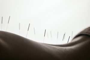 accupuncture calgary