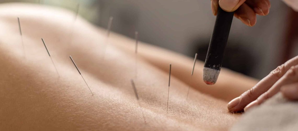 Woman is lying on her stomach on an acupuncture bed, getting a treatment with acupuncture needles and moxa.